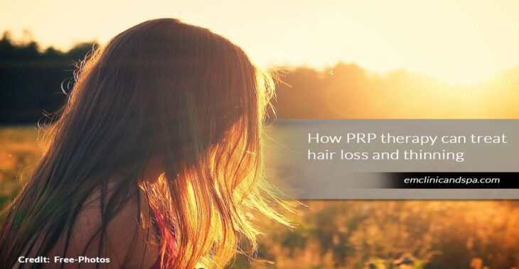 Treating Hair Loss with PRP