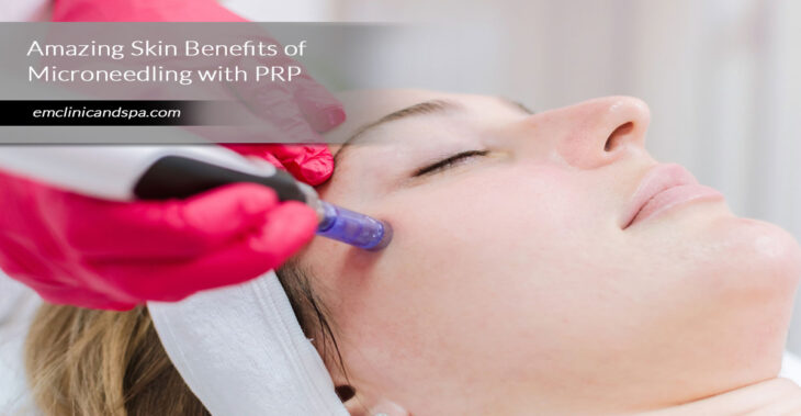 Amazing Skin Benefits of Microneedling with PRP