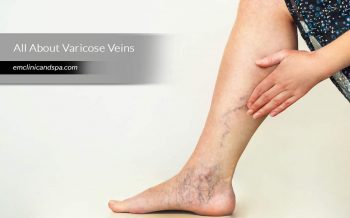 All About Varicose Veins