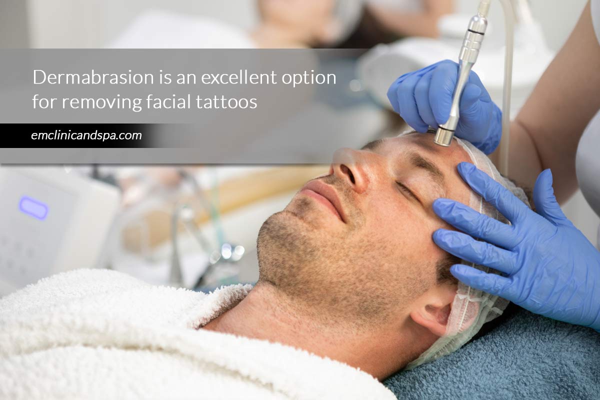 Dermabrasion is an excellent option for removing facial tattoos
