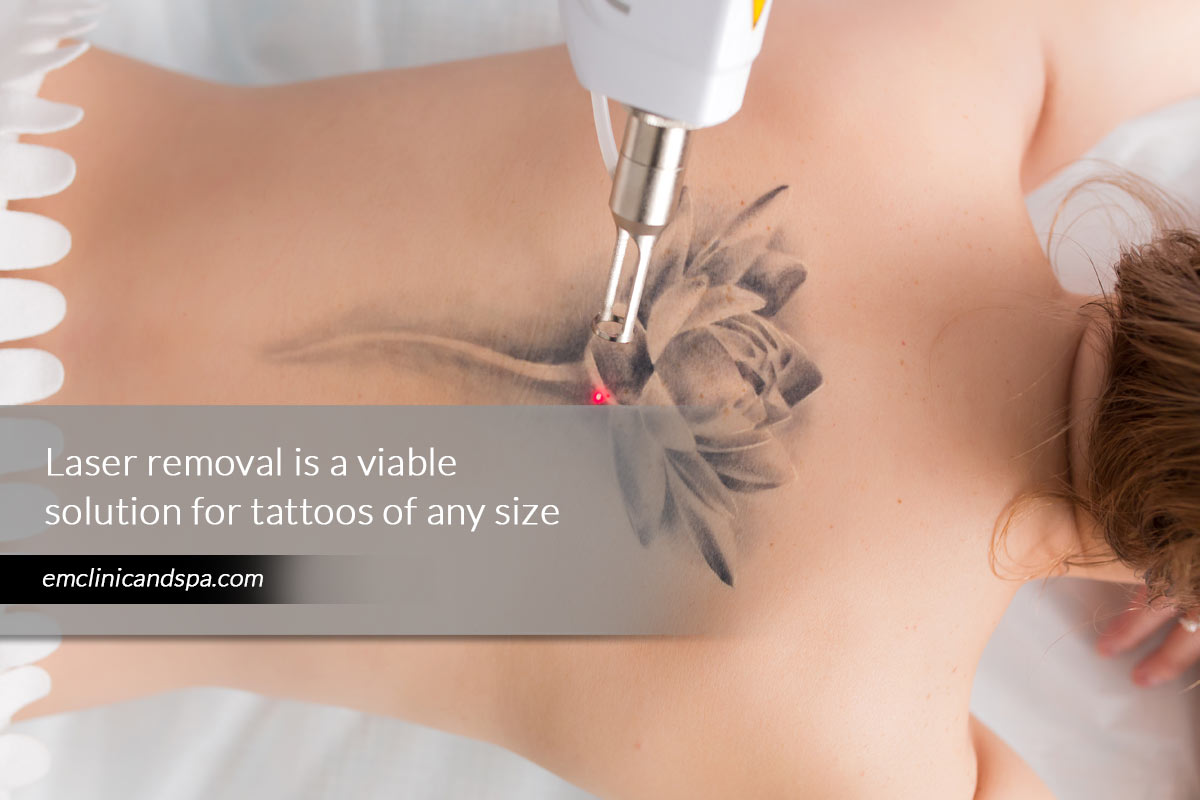 Laser removal is a viable solution for tattoos of any size