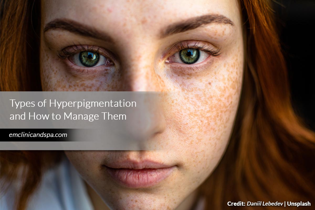 Types of Hyperpigmentation and How to Manage Them