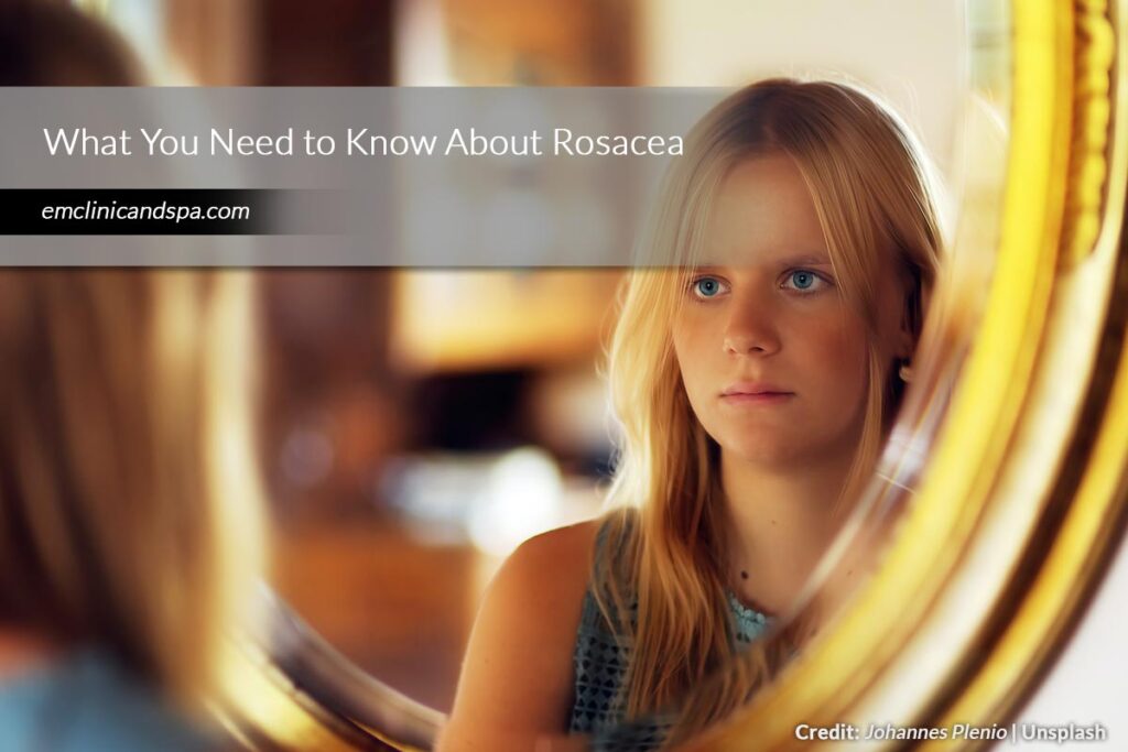 What You Need to Know About Rosacea
