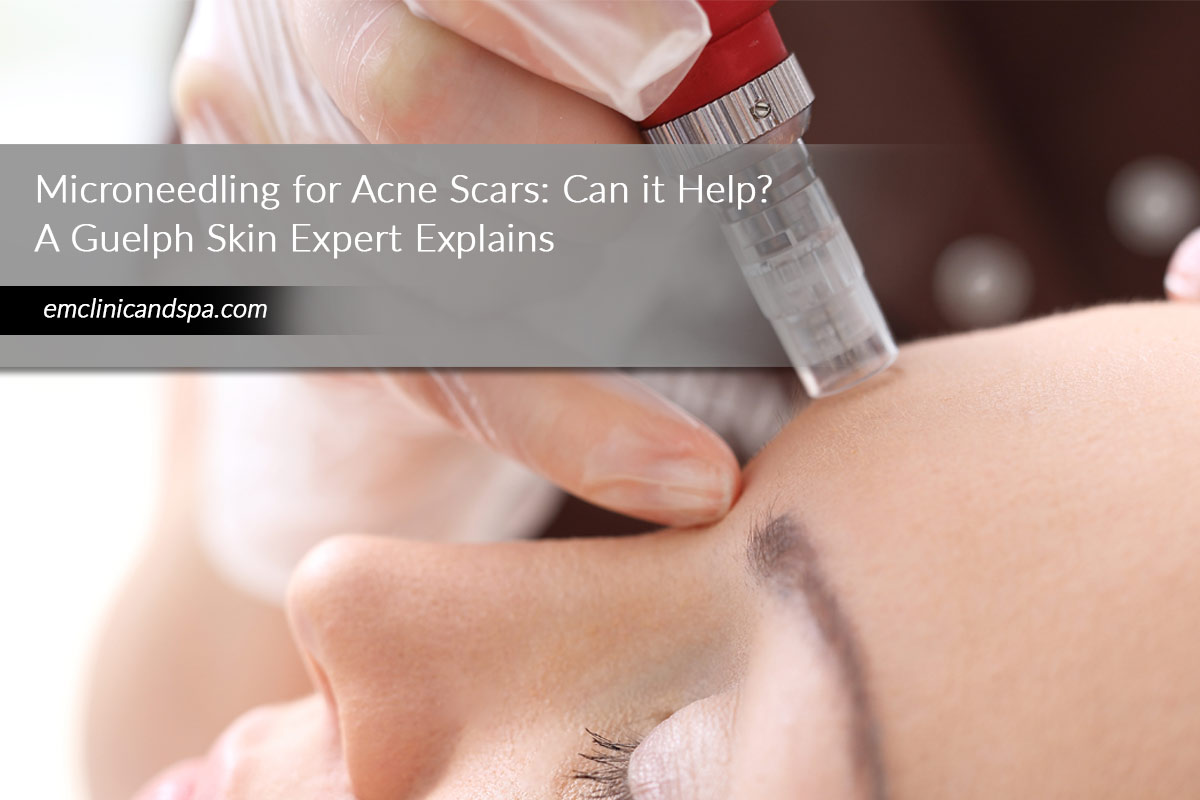 Microneedling for Acne Scars: Can it Help? A Guelph Skin Expert Explains