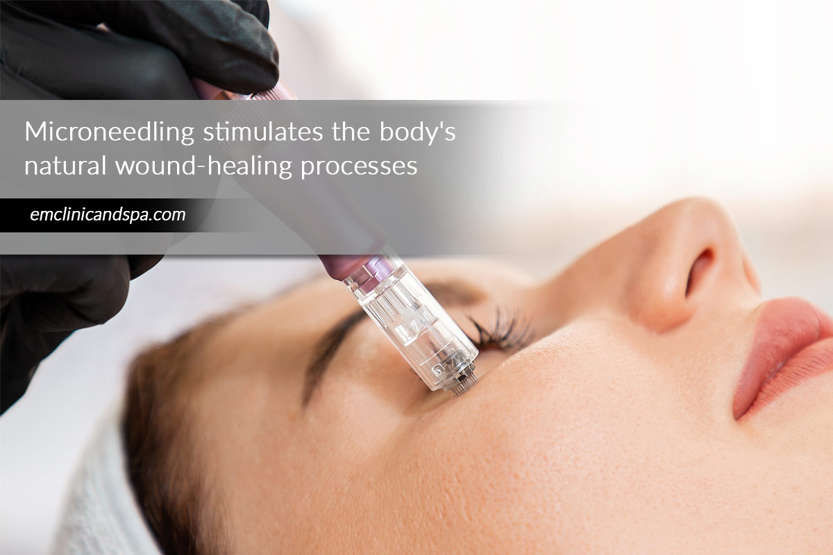 Microneedling stimulates the body's natural wound-healing processes