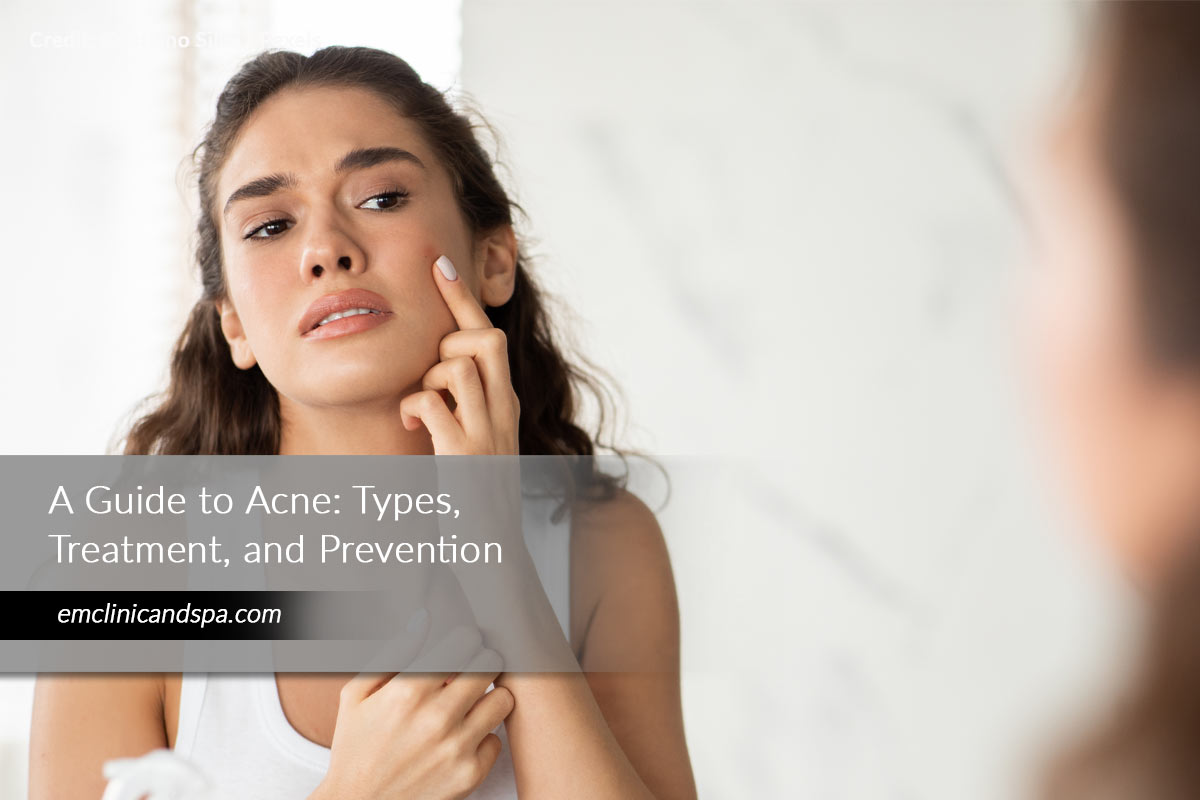 A Guide to Acne: Types, Treatment, and Prevention