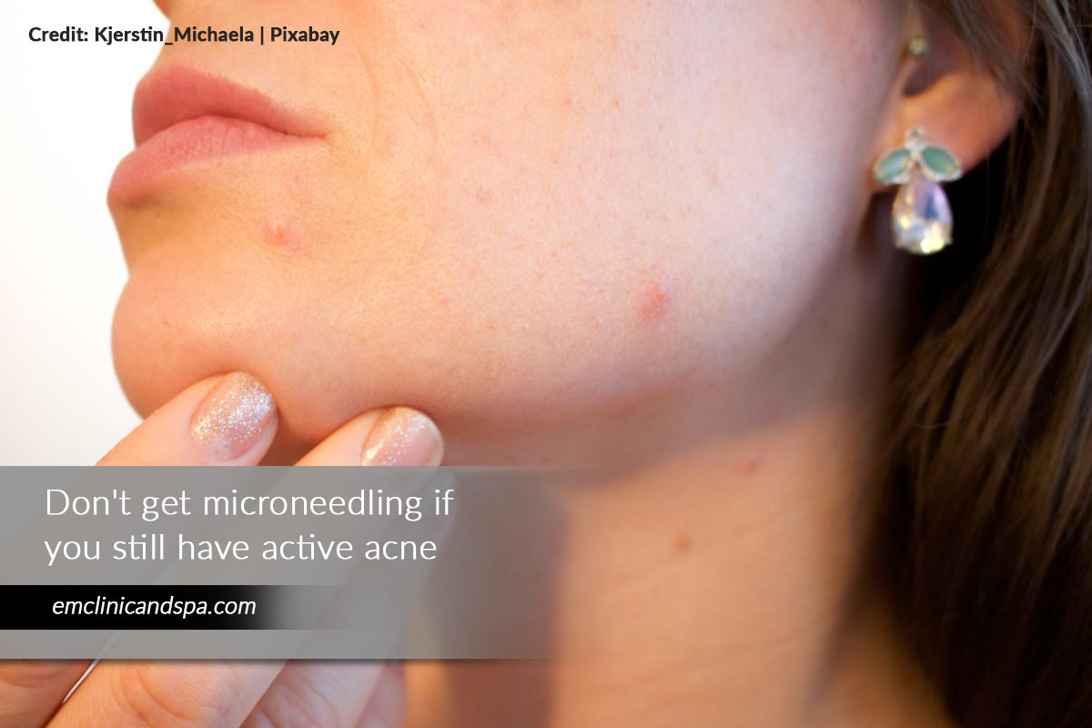 Don't get microneedling if you still have active acne