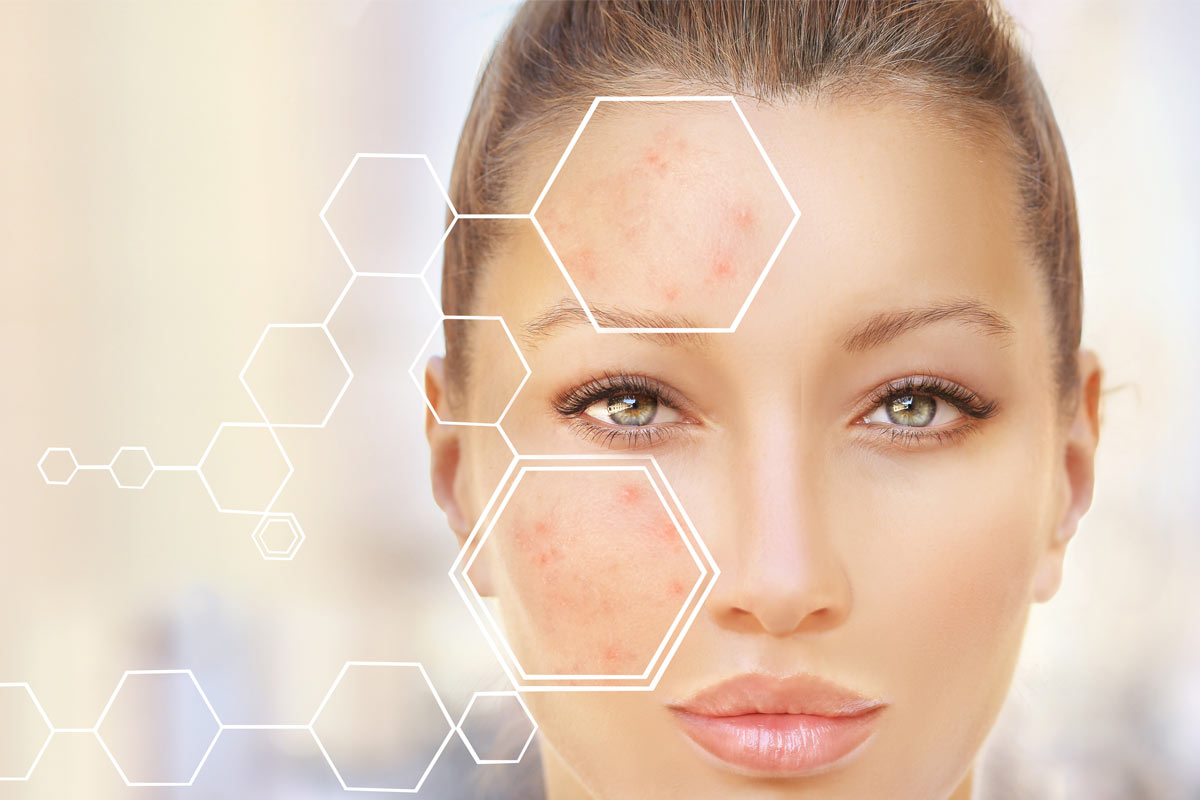 Get rid of acne scars with the right treatment