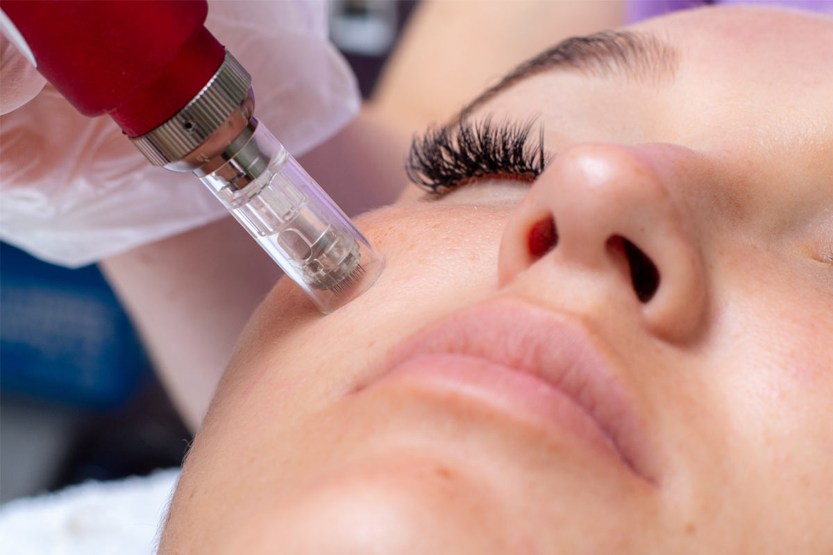 Microneedling helps repair damage caused by acne scars