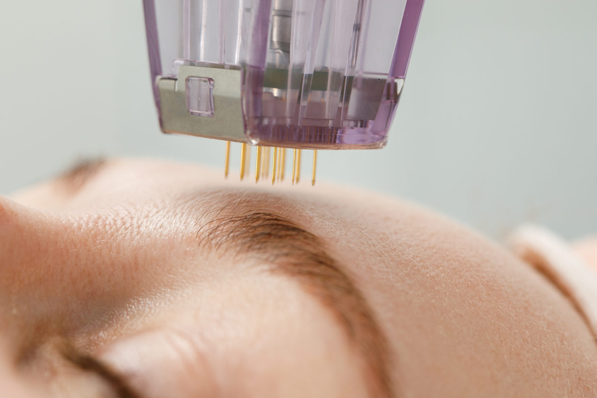 Microneedling stimulates the body's natural wound healing processes